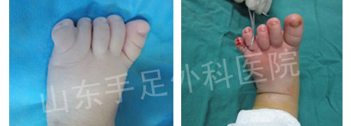 脚趾并指类型有哪些,不同类型并指,微创手术手法有所不同